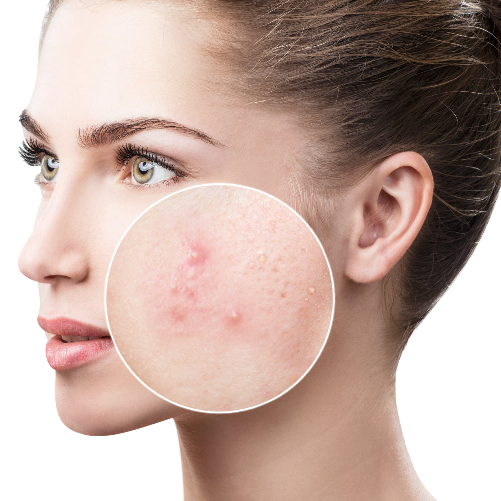Does Sulfur Help Alleviate Acne?